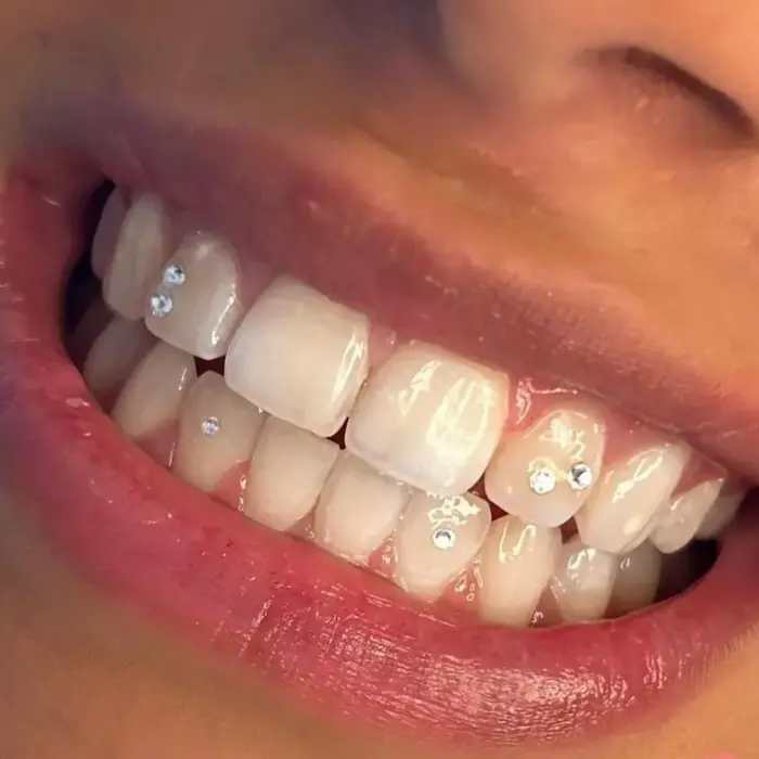 Nahaufnahme eines lächelnden Mundes mit mehreren kleinen Strasssteinen auf den Vorderzähnen.